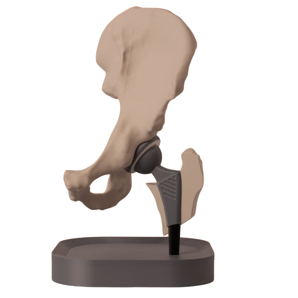 Anatomisk hofte – total hofteprotese