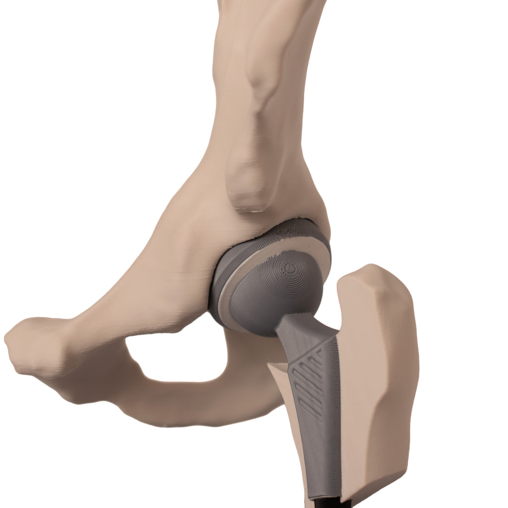 Anatomisk hofte – total hofteprotese