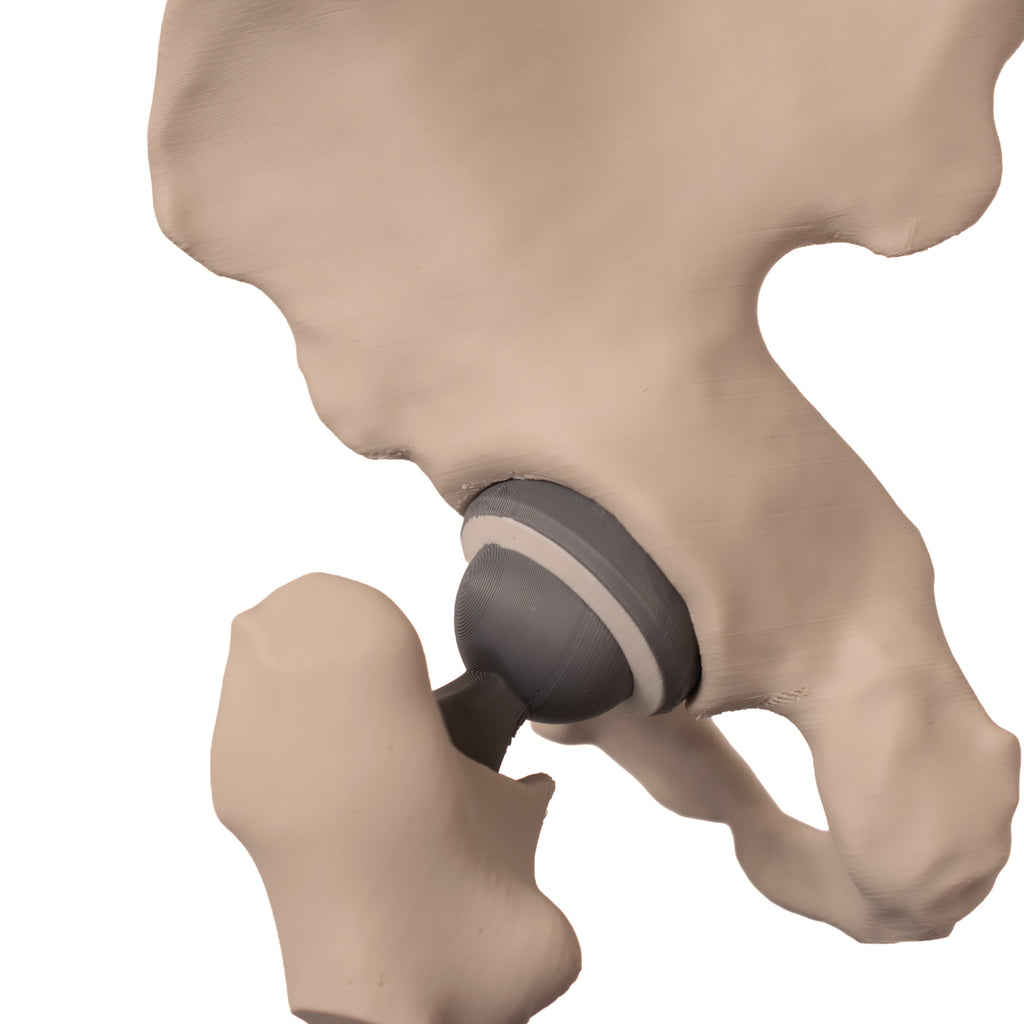 Anatomisk hofte – total hofteprotese