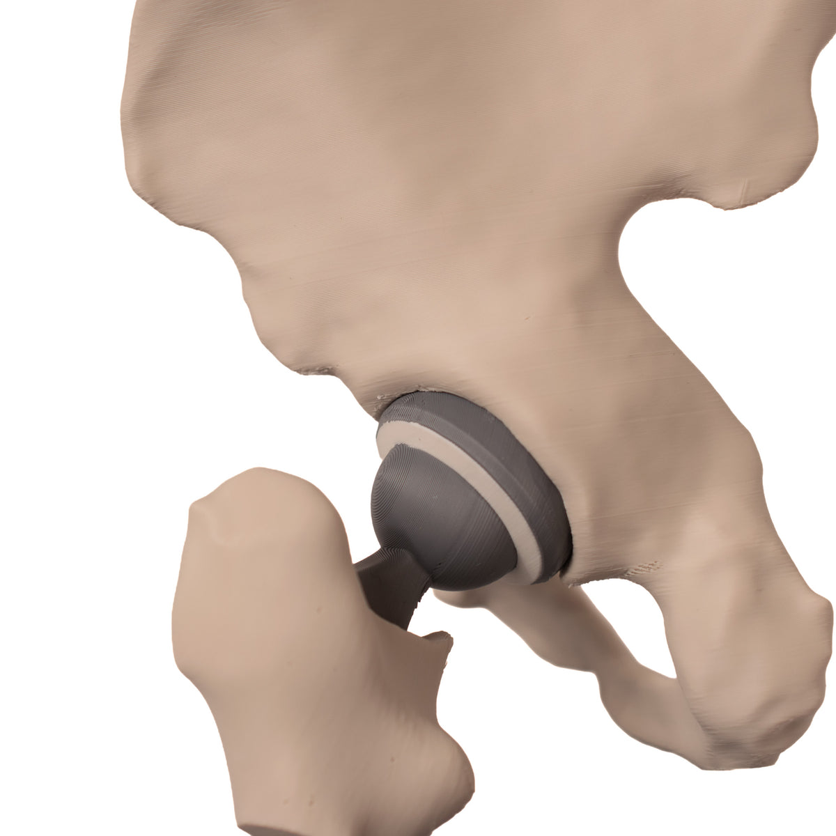 Anatomisk hofte – total hofteprotese